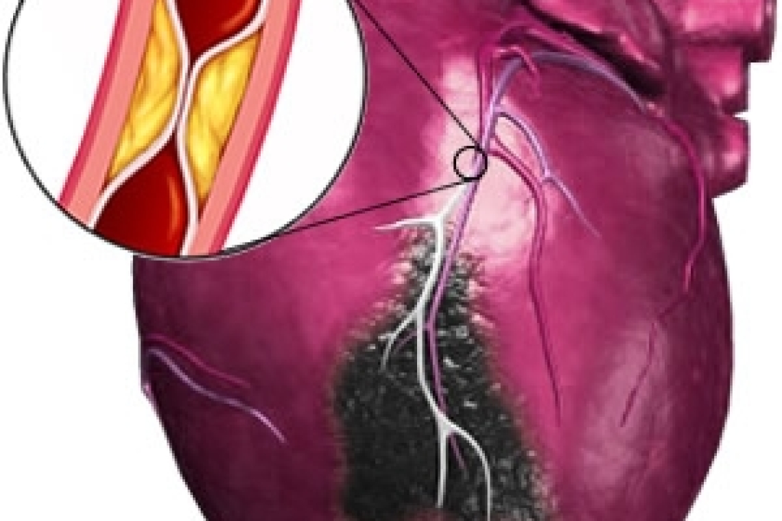 Ишемическая болезнь сердца во время беременности