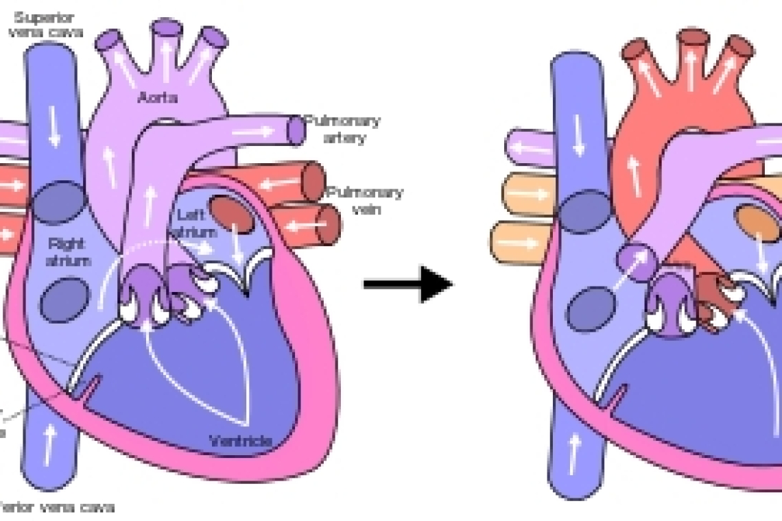 Беременность и Врожденный порок сердца