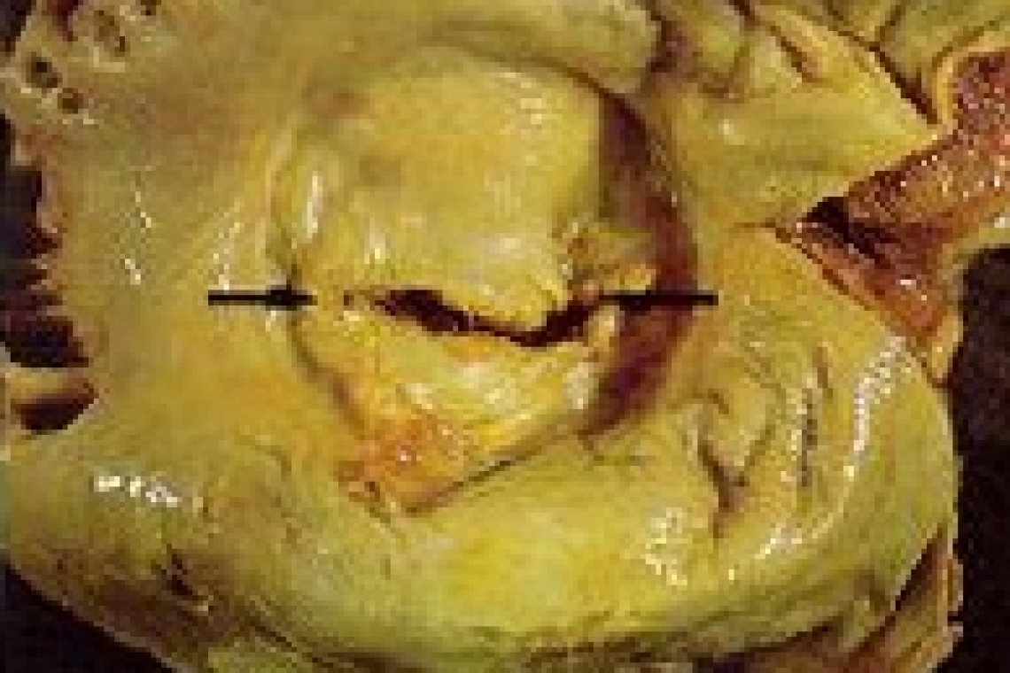 Пороки клапанов сердца во время беременности.
