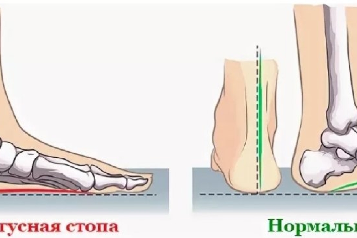 Упражнения от плоскостопия