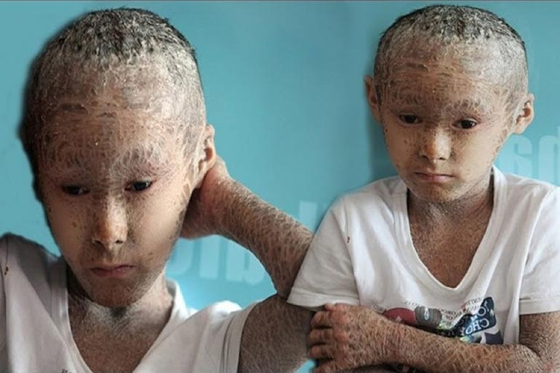 Врожденная патология, болезнь Ихтиоз. Ребенок Арлекин.